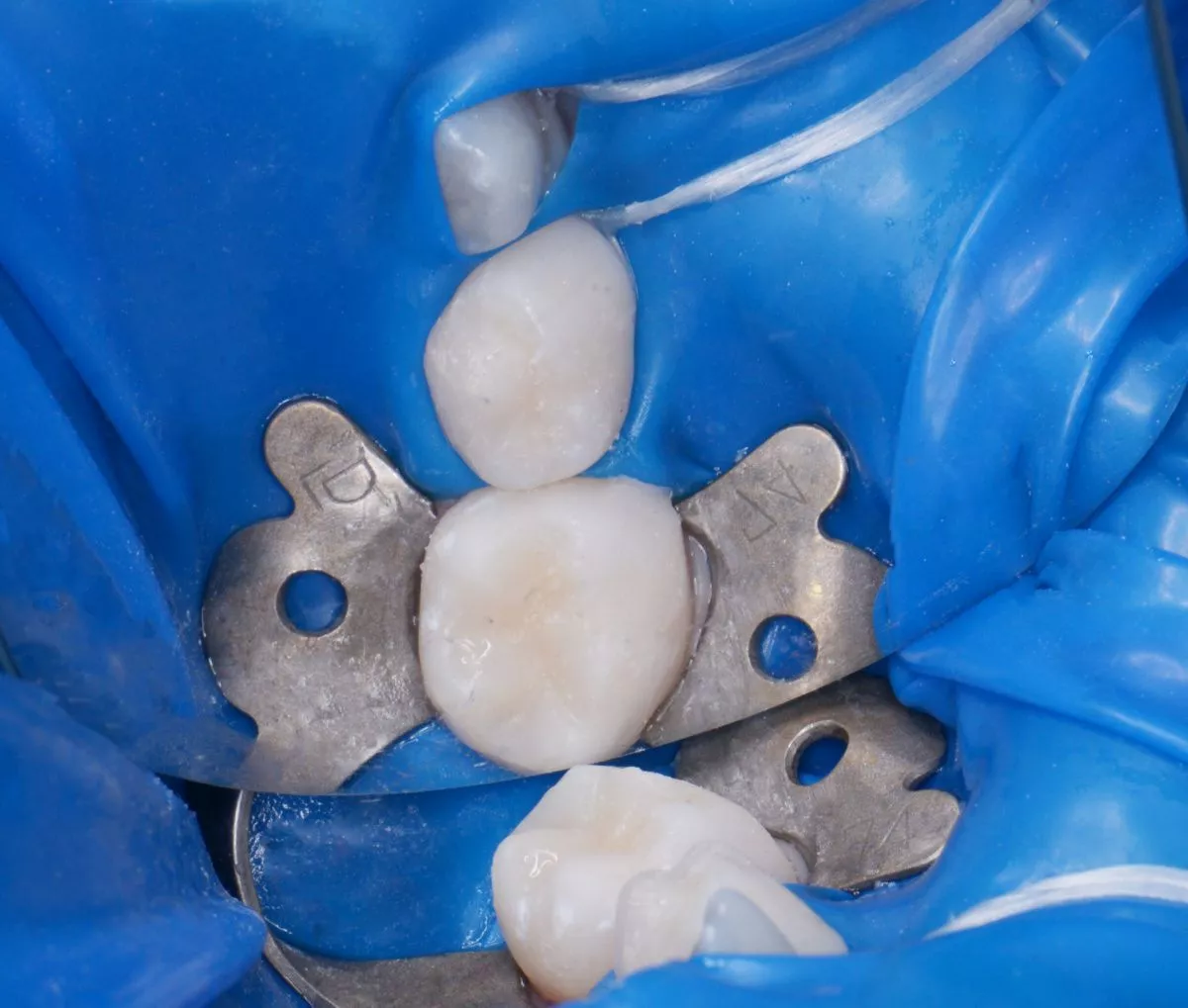 етская стоматология под наркозом Москва. Лечение кариеса детям