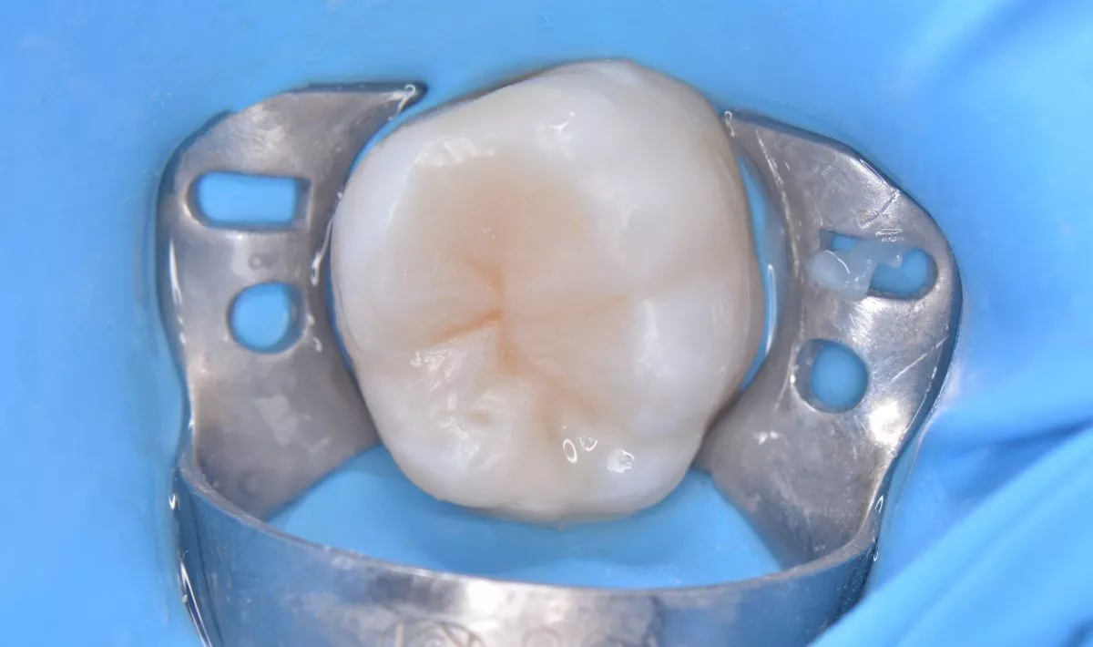 Детская стоматология в Москве. Лечение кариеса с восстановлением анатомии зуба у детей