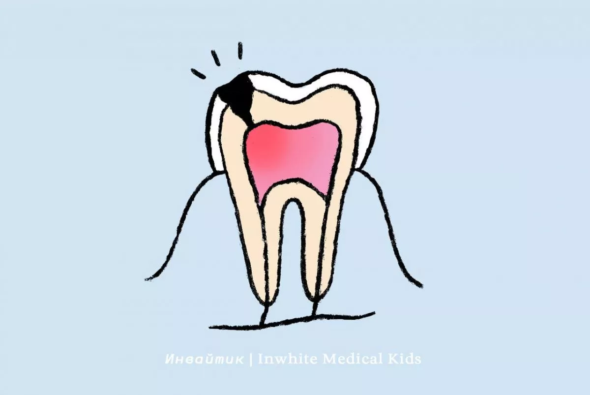 Как мы лечим пульпит у детей?