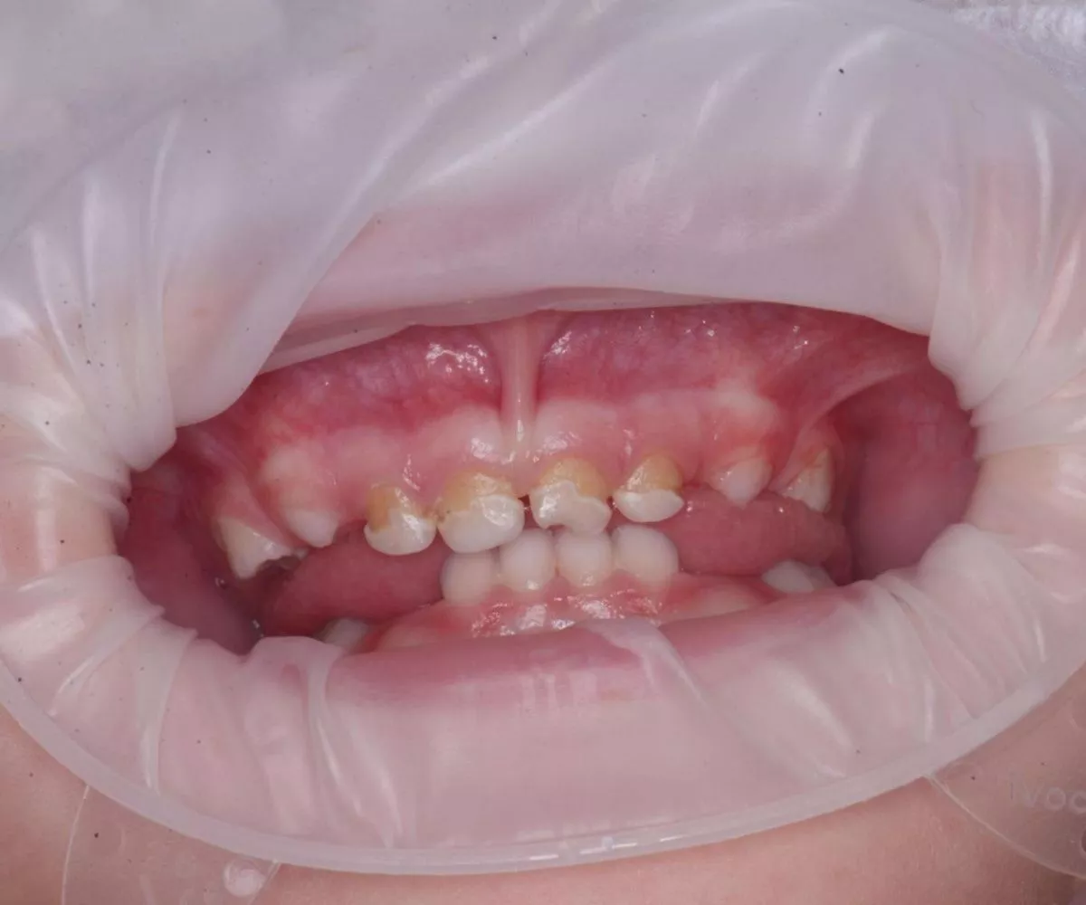 Детская стоматология с наркозом. Лечение молочных зубов во сне - до процедуры