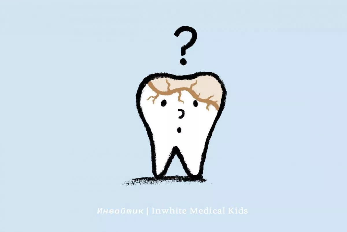 Почему у ребёнка может появиться кариес под пломбой?