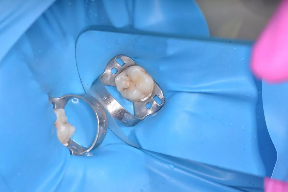 Детская стоматология с наркозом. Лечение кариеса жевательного зуба - до процедуры