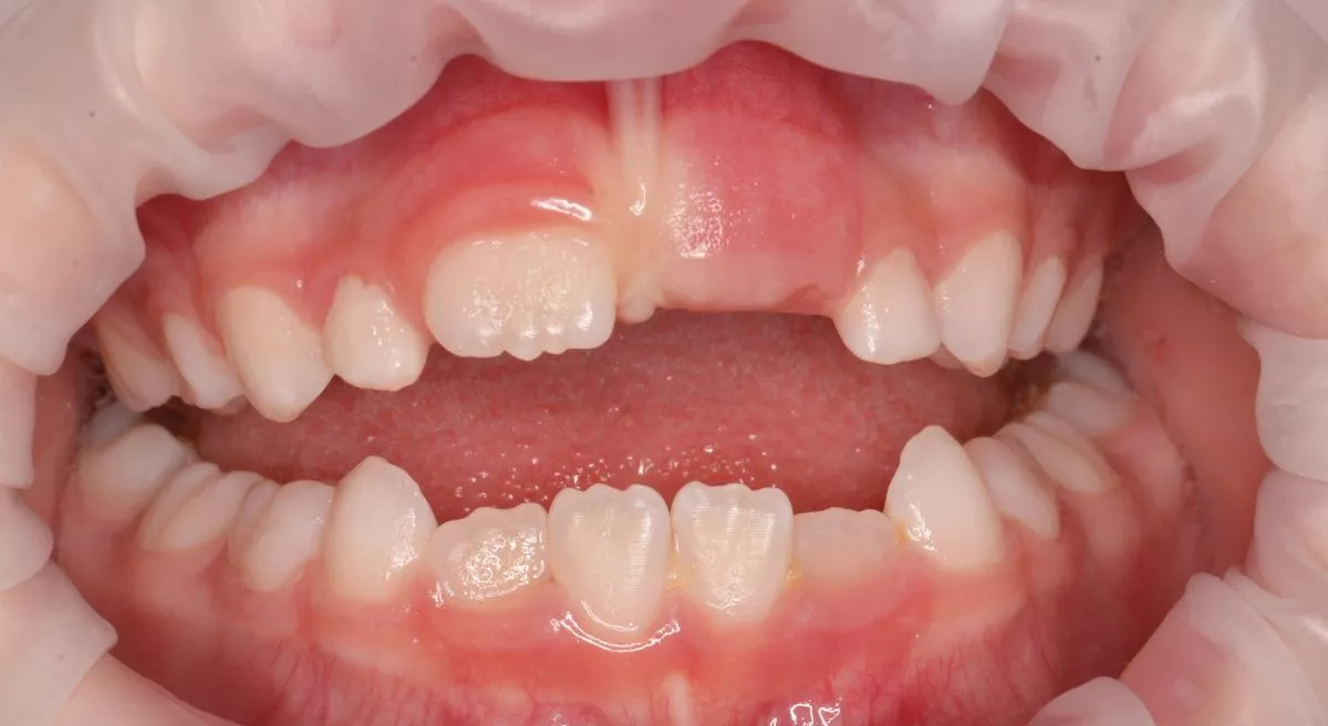 етская стоматология под наркозом Москва. Профессиональная гигиена зубов у детей - до процедуры