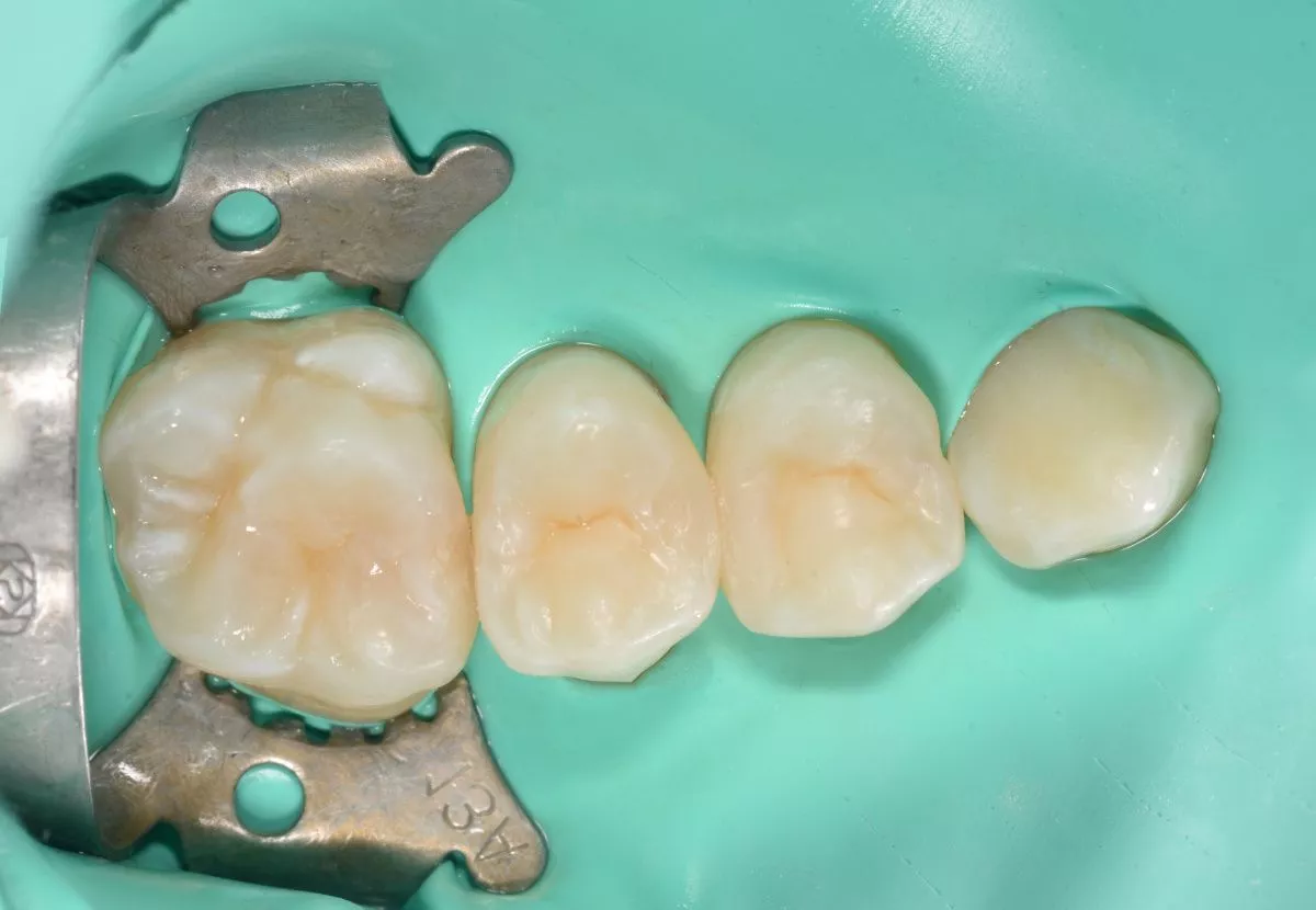 Детская стоматология в Москве. Лечение контактного кариеса 2-х зубов у детей