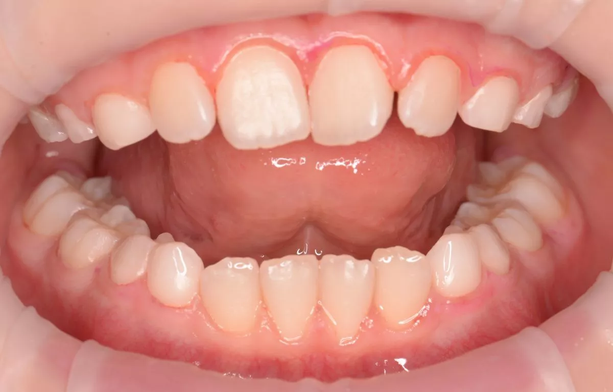 етская стоматология под наркозом Москва. Профессиональная гигиена зубов детям