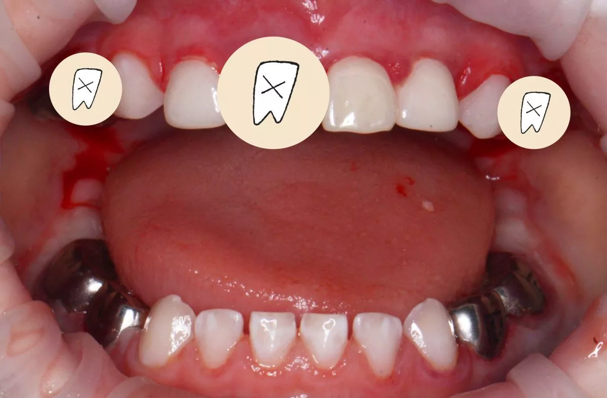 етская стоматология лечение под наркозом. Лечение во сне - установка коронок, удаление зубов и проведение профессиональной гигиены