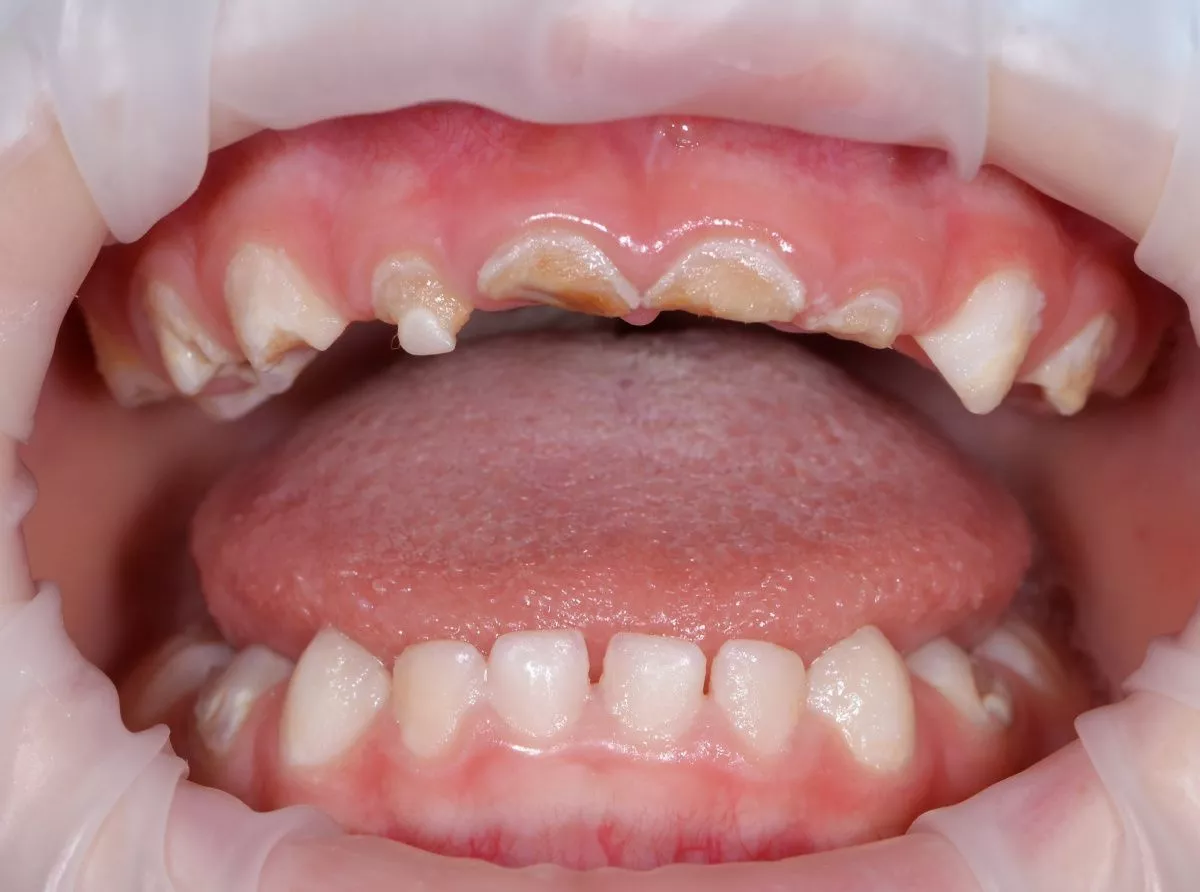 етская стоматология лечение под наркозом. Лечение детей во сне - установка коронок и проведение гигиены зубов - до процедуры