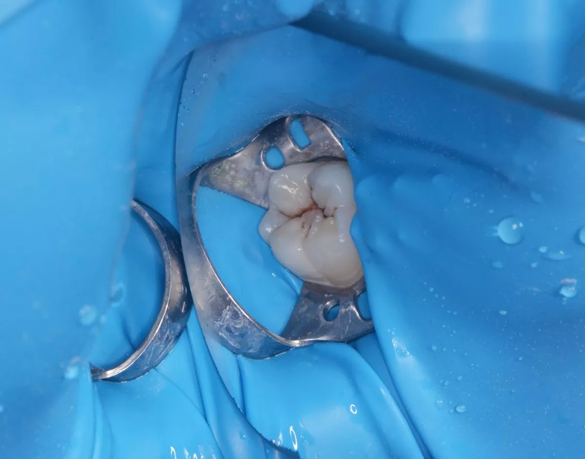 Детская стоматология с наркозом. Лечение кариеса постоянного зуба у детей - до процедуры