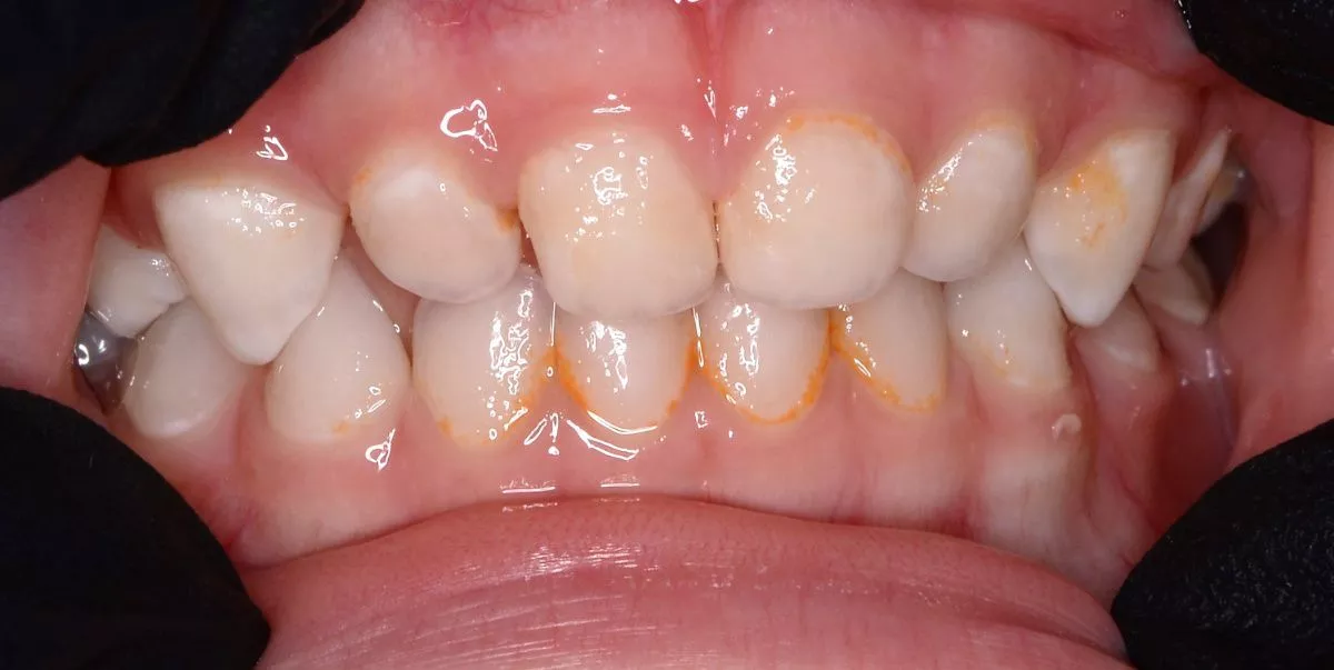 етская стоматология лечение под наркозом. Профессиональная гигиена для детей - до процедуры