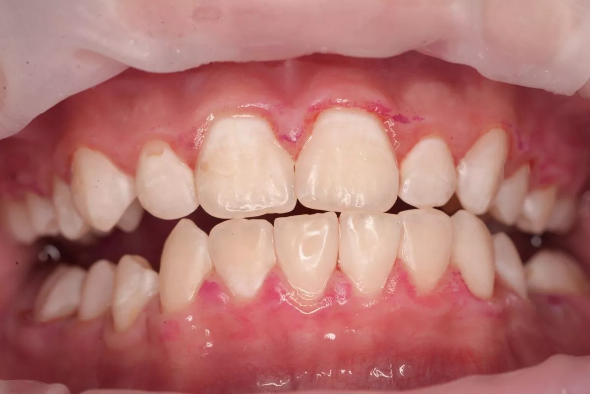 Детская стоматология Мичуринский. Гигиена зубов в сменном прикусе