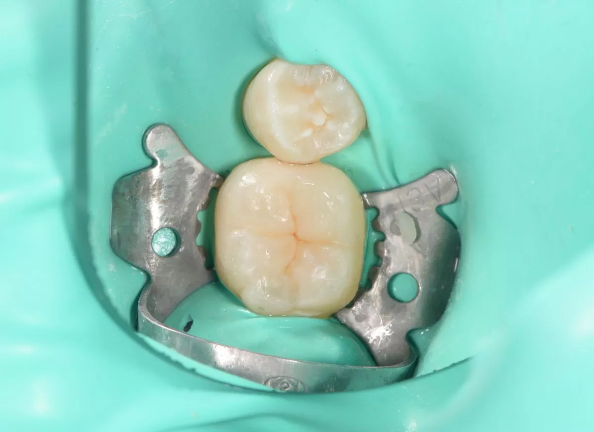 Детская стоматология в Москве. Лечение кариеса жевательного зуба детям