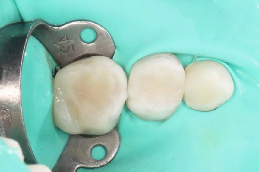 Лучшие детские врачи стоматологи. Лечение кариесов зубов у подростков