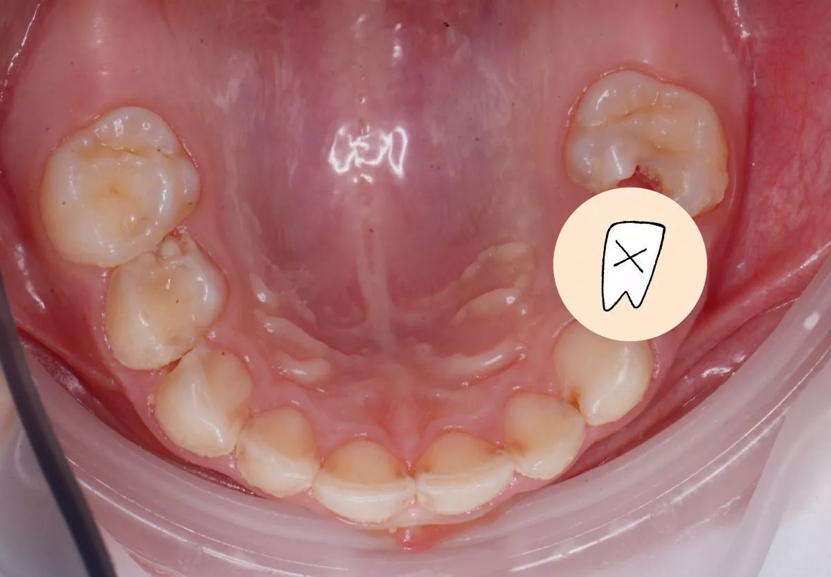 етская стоматология под наркозом Москва. Лечение молочных зубов и установка металлических коронок во сне - до процедуры
