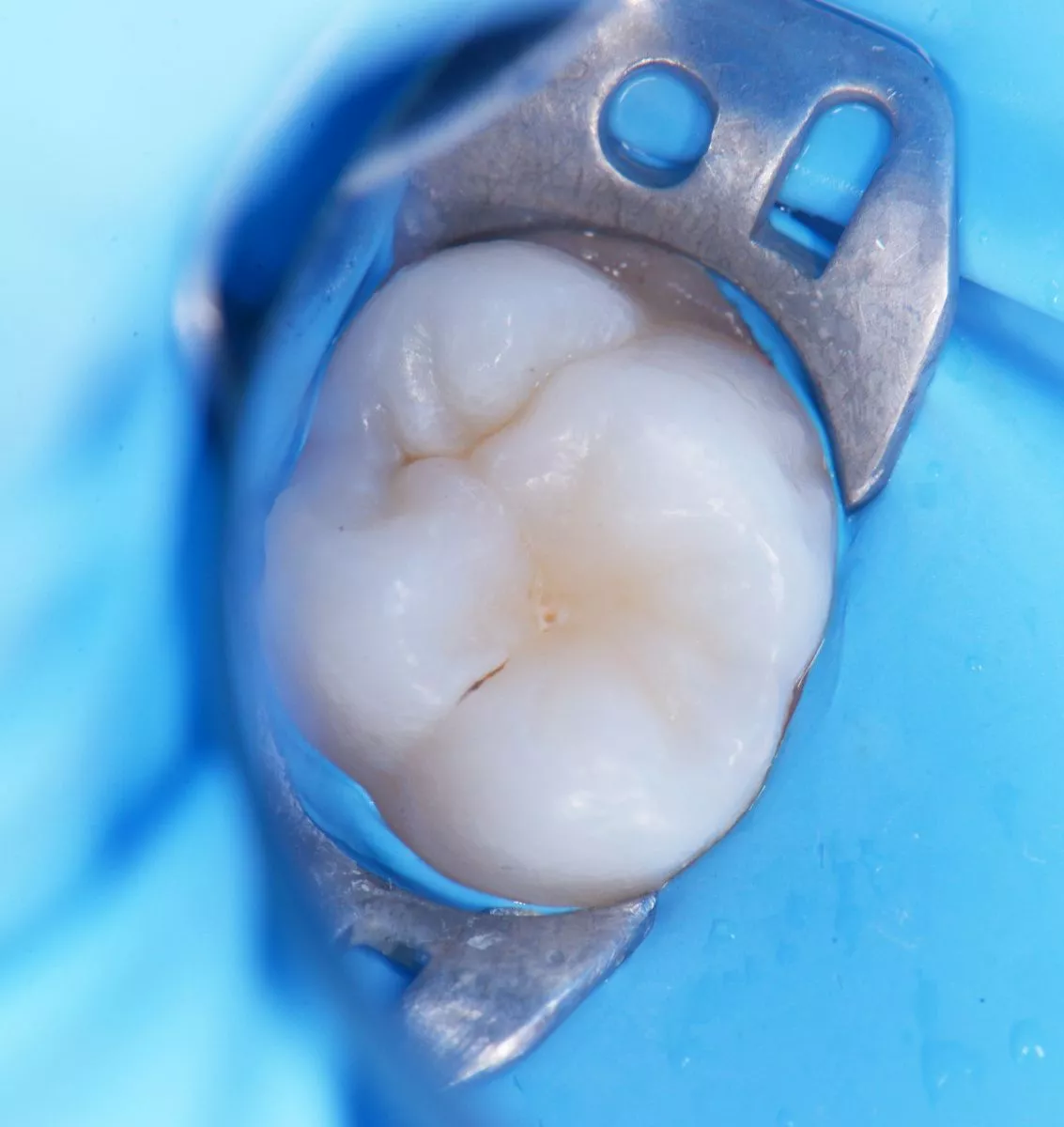 Детская стоматология Мичуринский. Лечение скрытого кариеса постоянного зуба у детей - до процедуры