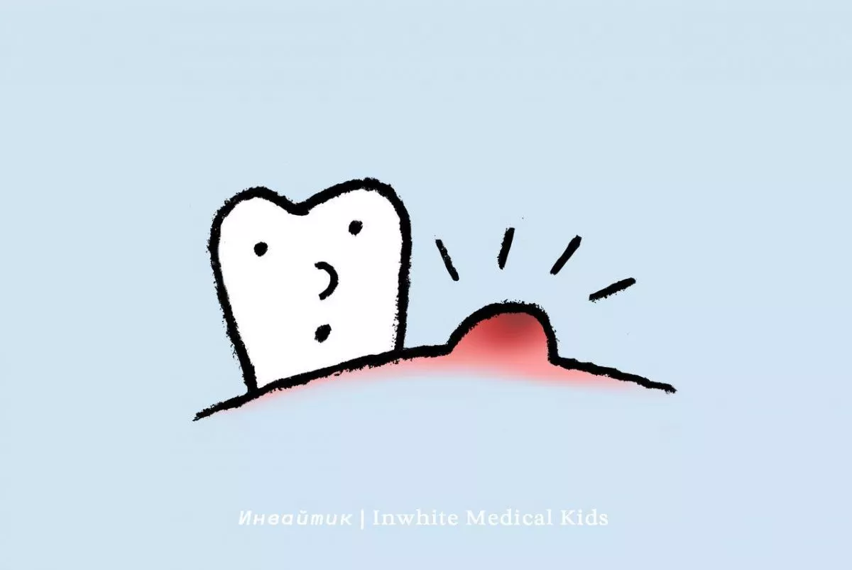 У ребёнка появилась язвочка в полости рта. Это стоматит?