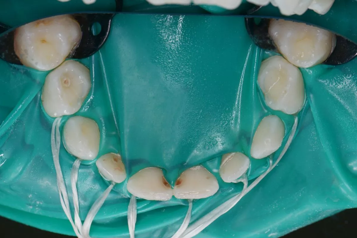 етская стоматология под наркозом Москва. Лечение множественных кариесов у детей - до процедуры