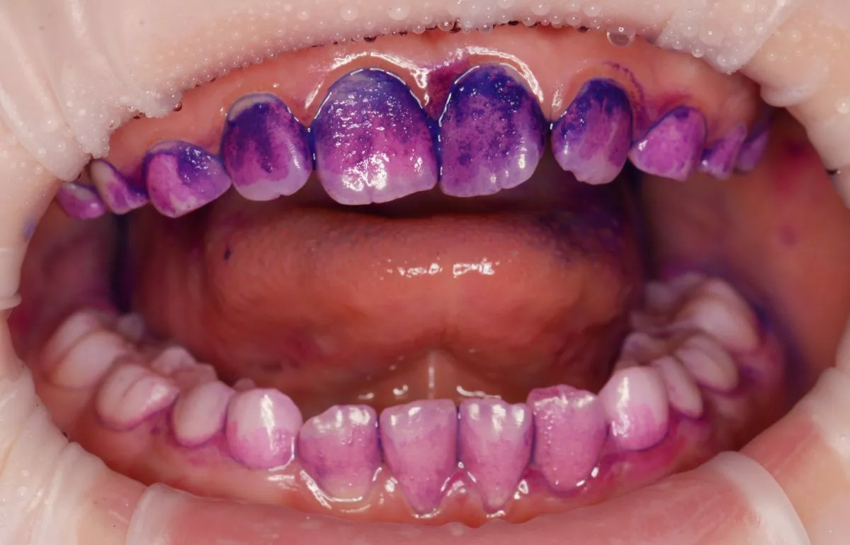 етская стоматология под наркозом Москва. Профессиональная гигиена зубов детям - до процедуры