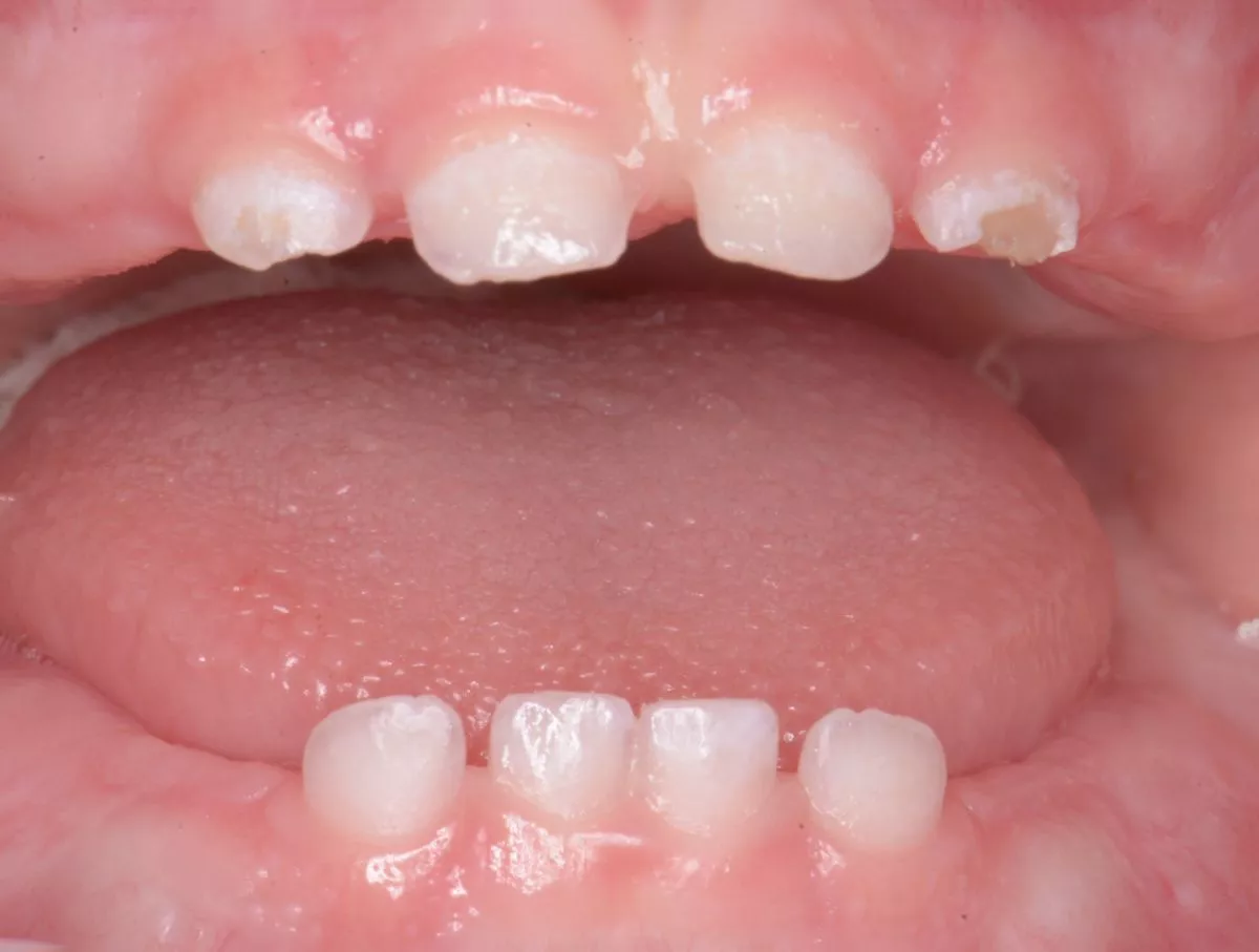 Детская стоматология с наркозом. Лечение под наркозом - установка коронок и профессиональная гигиена - до процедуры