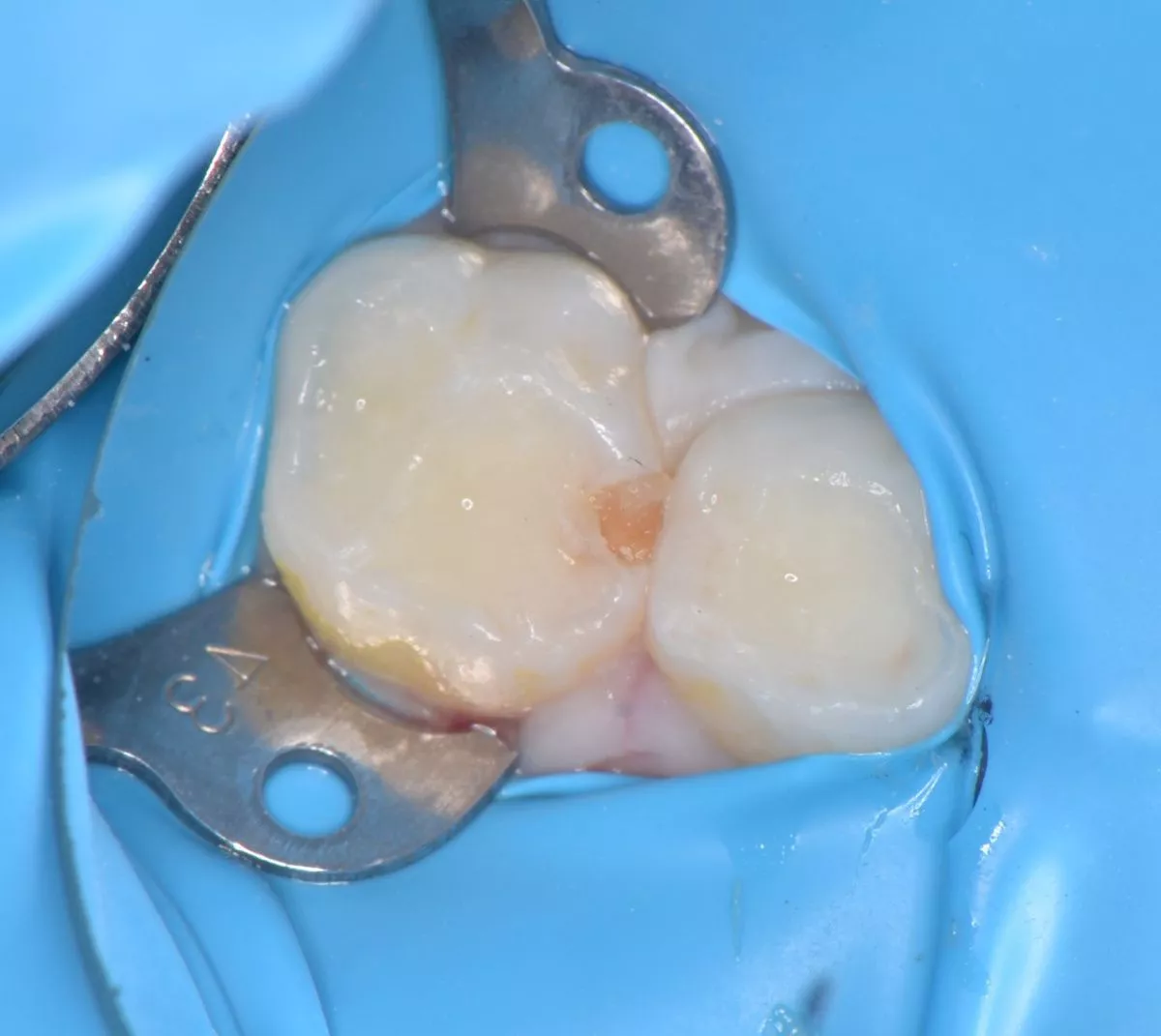 етская стоматология лечение под наркозом. Лечение межзубного кариеса у детей - до процедуры