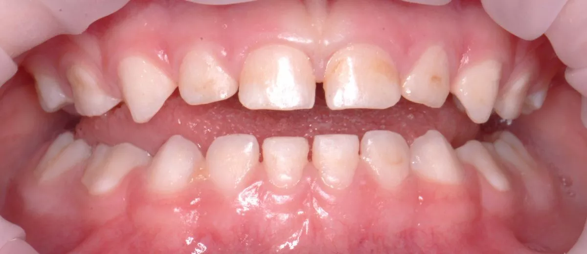 етская стоматология лечение под наркозом. Лечение зубов в седации для детей - до процедуры