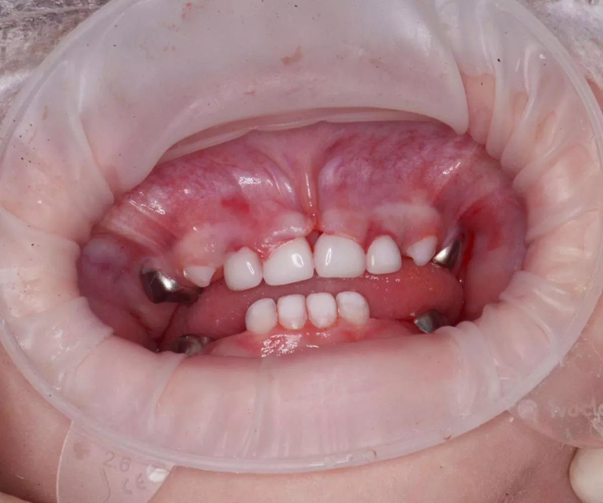 Детская стоматология с наркозом. Лечение молочных зубов во сне