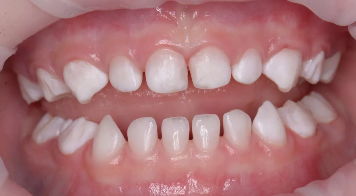 Детская стоматология Мичуринский. Гигиена в сменном прикусе у детей