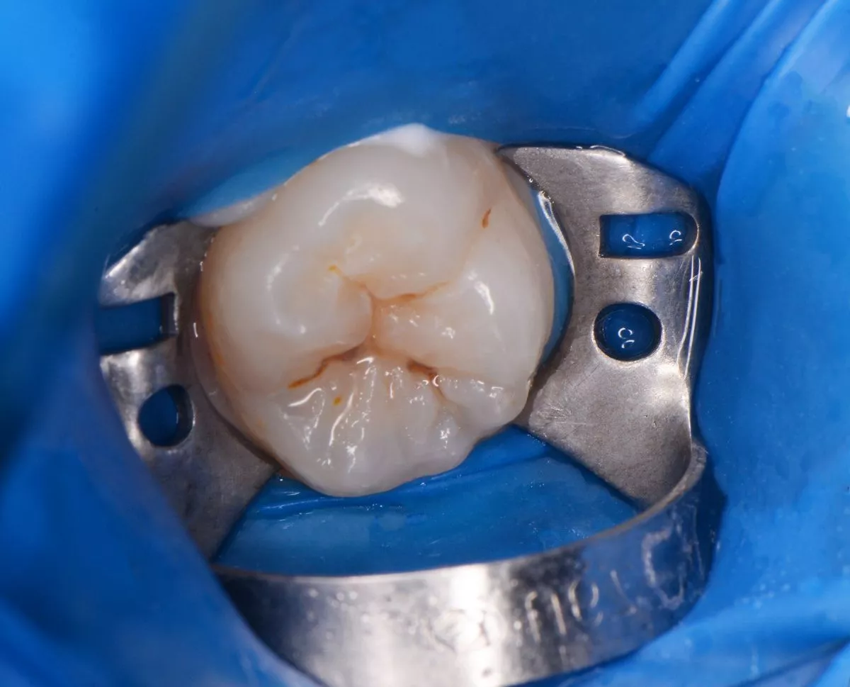 Детская стоматология Мичуринский. Лечение скрытого кариеса постоянного зуба у детей - до процедуры