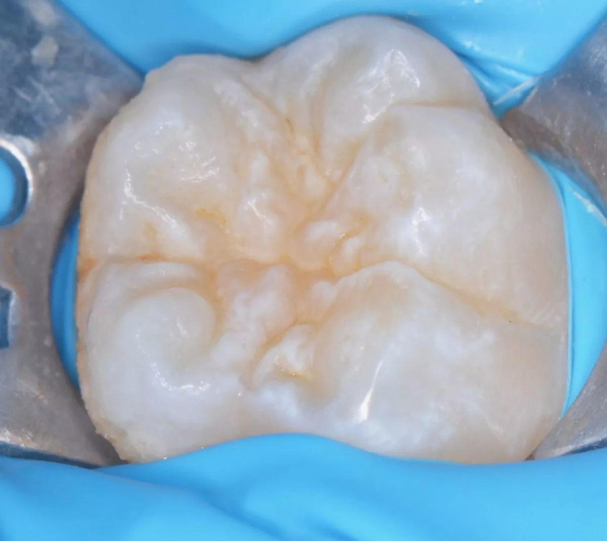 етская стоматология лечение под наркозом. Герметизация фиссур постоянного зуба у детей - до процедуры