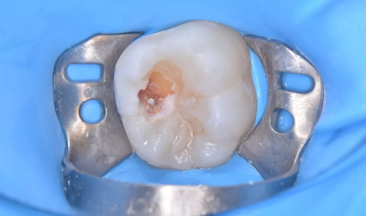 Детская стоматология в Москве. Лечение кариеса с восстановлением анатомии зуба у детей - до процедуры