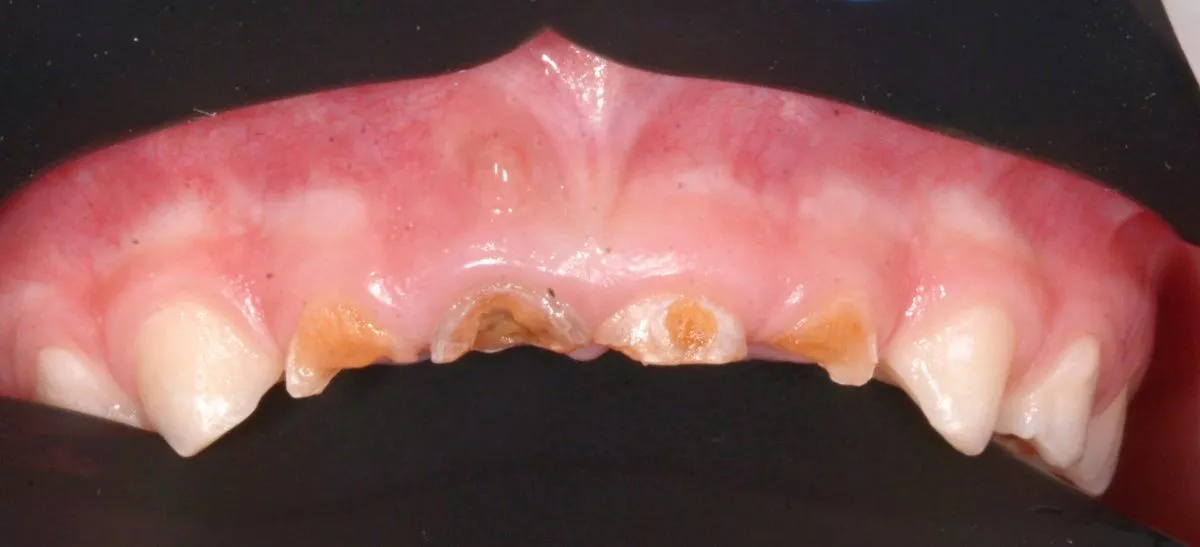 етская стоматология лечение под наркозом. Лечение зубов в наркозе детей - до процедуры