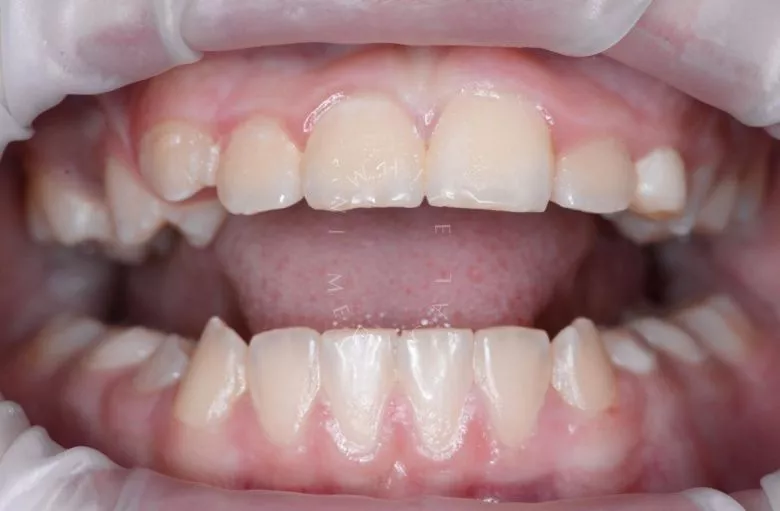 Лучшие детские стоматологии. Гигиена сменного прикуса - фото до процедуры