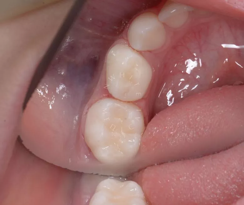 Самые лучшие детские стоматологи. Лечение контактного кариеса у детей - фото после процедуры