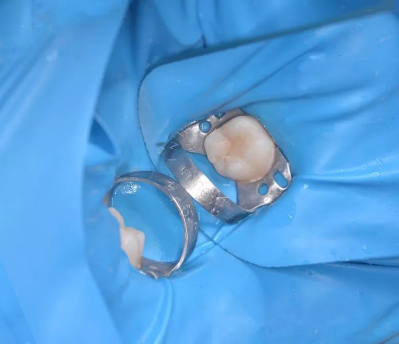 Лучшие стоматологии детские платные. Лечение кариеса у детей с восстановлением фиссур - фото после процедуры