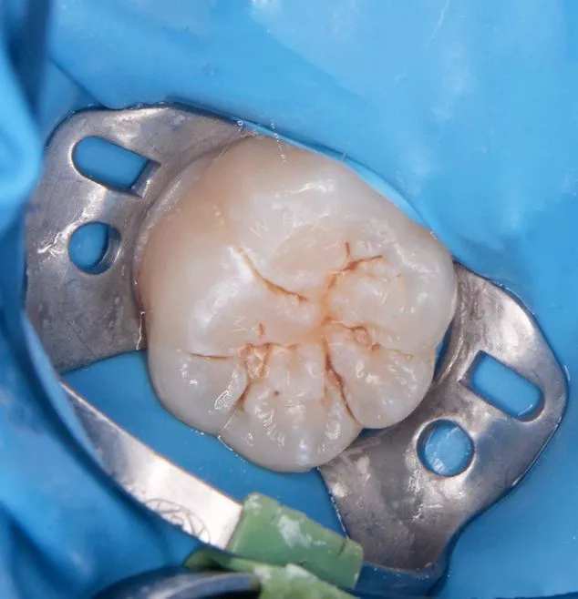 Фото до Лечение кариеса жевательного зуба детям в клинике Inwhite Medical