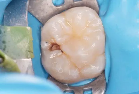 Фото до Лечение кариеса жевательного зуба детям в клинике Inwhite Medical