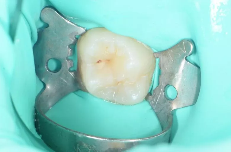 Детская стоматология Раменки. Лечение кариеса жевательного зуба у подростка - фото до процедуры