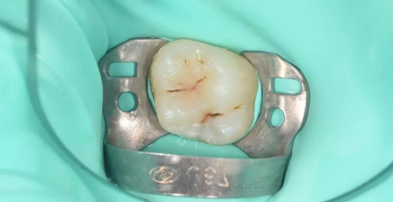 Детская стоматология Раменки. Лечение кариеса жевательного зуба у ребенка - фото до процедуры