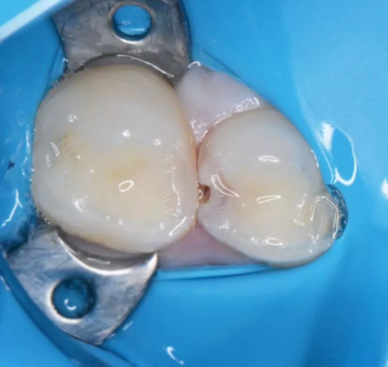 Лучшие стоматология для детей. Лечение контактного кариеса детям - фото до процедуры