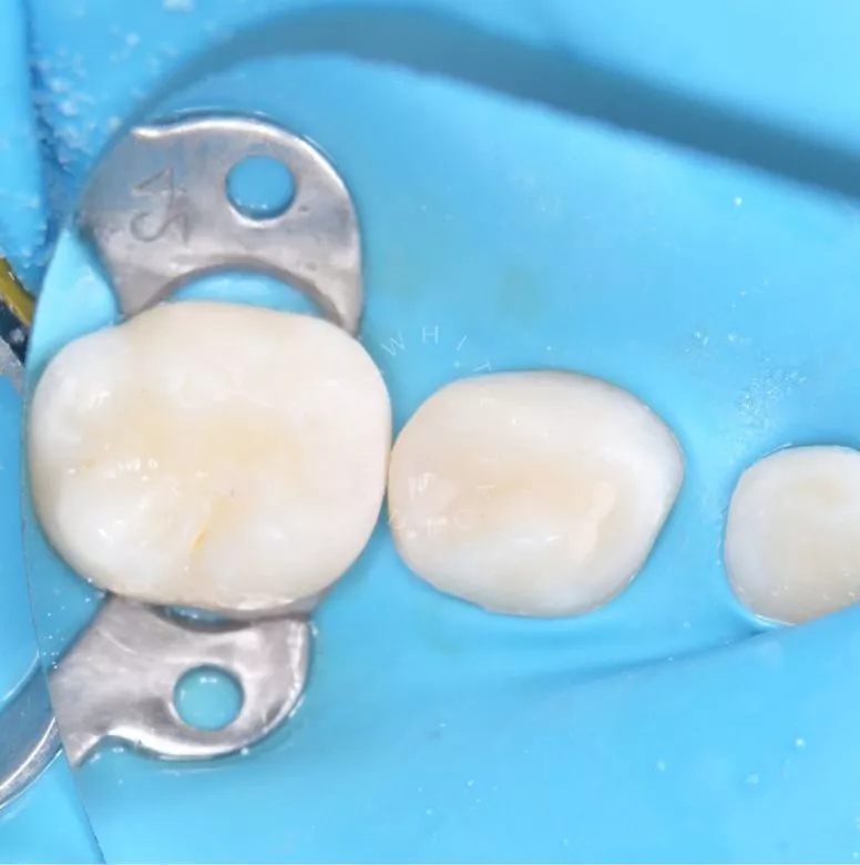 Лучшие стоматология для детей. Лечение контактного кариеса зуба - фото после процедуры