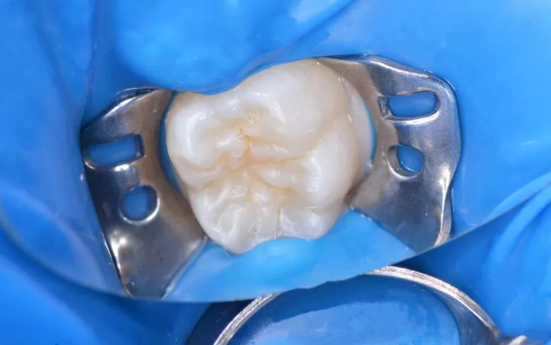 Фото после Герметизация фиссур постоянных зубов у детей в клинике Inwhite Medical