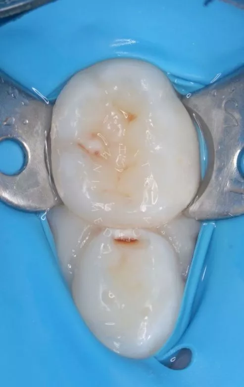 Лучшие стоматология для детей. Лечение кариеса с герметизацией фиссур детям - фото до процедуры