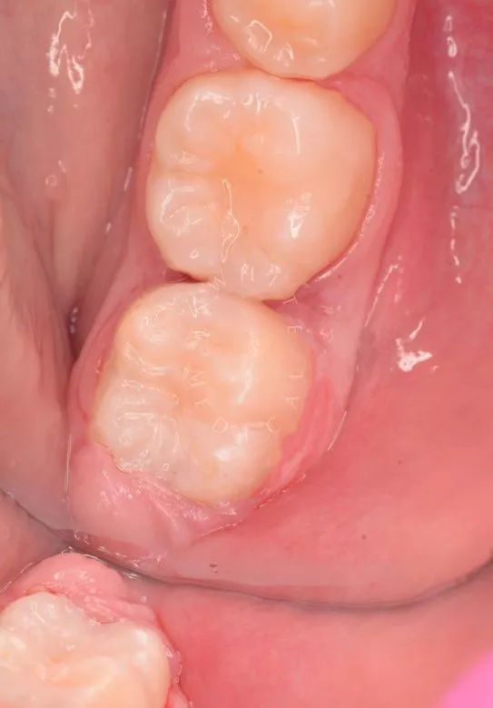  - фото после процедуры