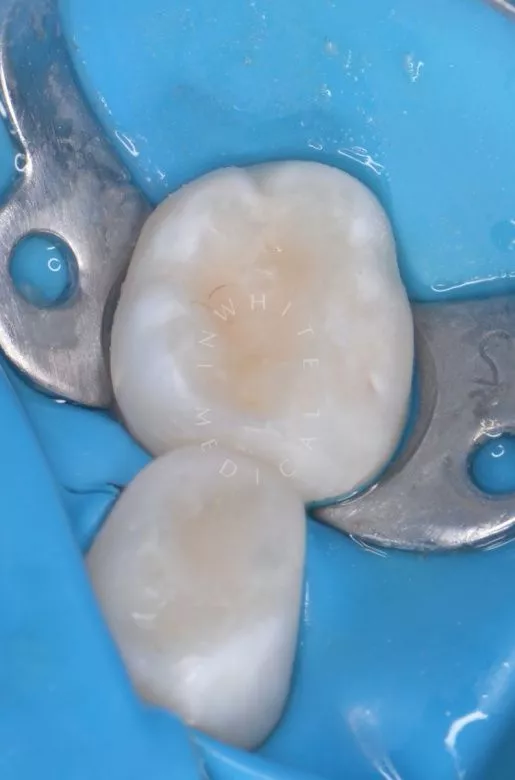 Лучшие стоматология для детей. Лечение кариеса с герметизацией фиссур детям - фото после процедуры