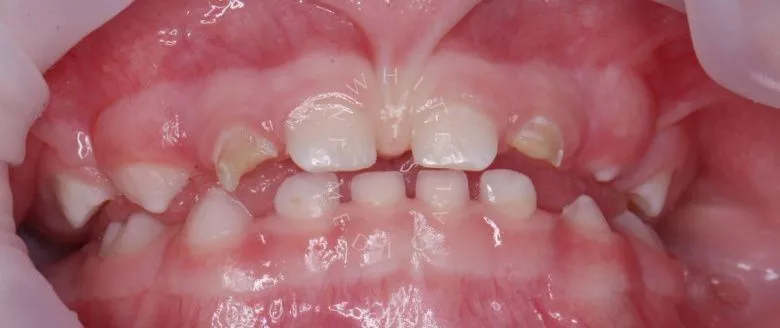 Лучшие стоматология для детей. Лечение под наркозом - установка коронок и профессиональная гигиена у детей - фото до процедуры