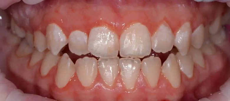  - фото после процедуры