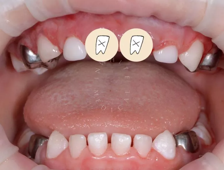 Лучшие стоматология для детей. Лечение детей во сне - установка коронок и проведение гигиены зубов - фото после процедуры