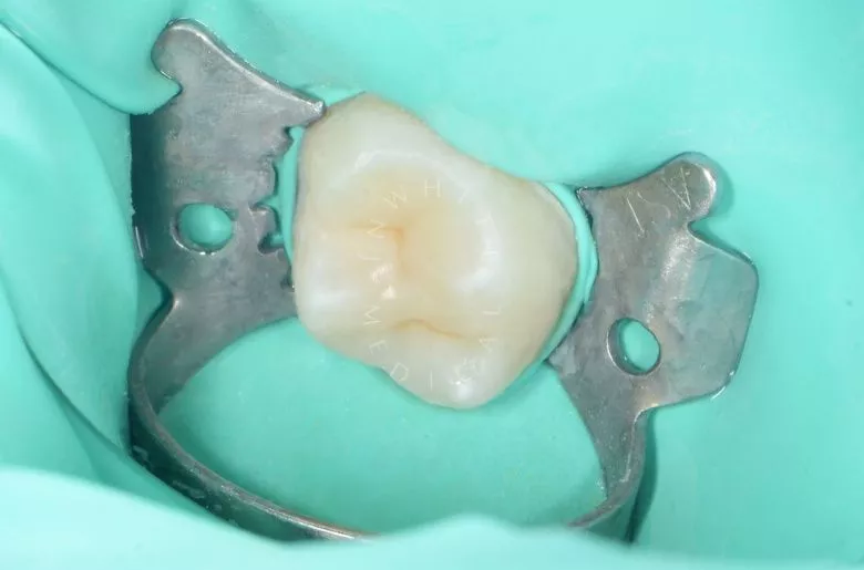 Детская стоматология Раменки. Лечение кариеса жевательного зуба у подростка - фото после процедуры