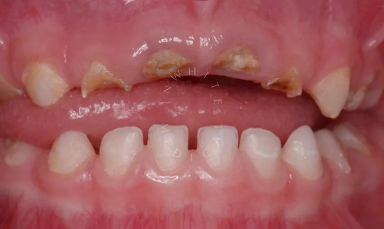 Лучшие стоматологии детские платные. Лечение во сне - установка керамических и металлических коронок - фото до процедуры