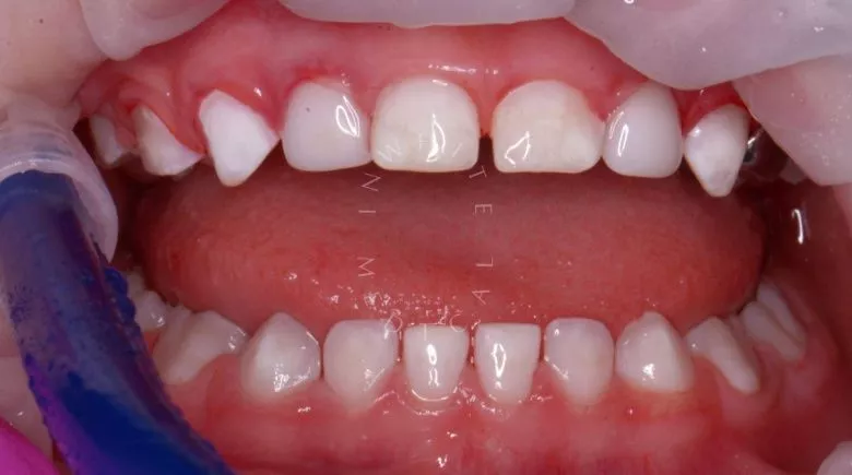 Лучшие стоматология для детей. Лечение зубов в седации для детей - фото после процедуры