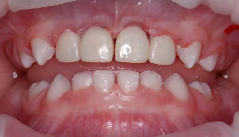 Лучшие стоматология для детей. Лечение под наркозом - профессиональная гигиена и установка 4 керамических коронок - фото после процедуры